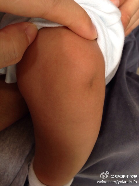 我家宝宝两个月,膝盖有凹陷,两条腿都有,对称分布.