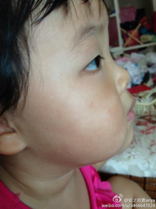 我女儿两岁五个月,从很小的时候脸上就长了这种白斑,形状不规则,请问