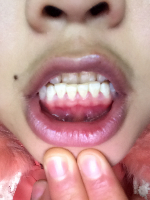 我的牙龈怎么变成这样了 麻烦专科医生帮我解答夏 <br?