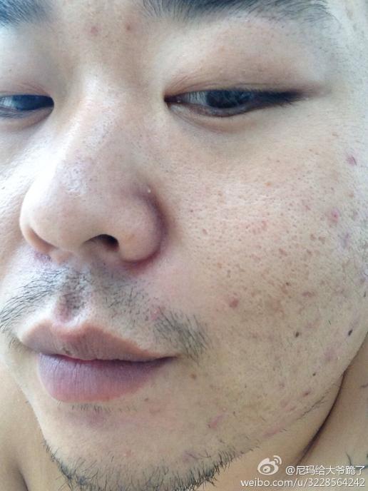 请教下我27岁脸上这红色的痘痘和痘疤以及毛孔粗大要怎么治疗哦?