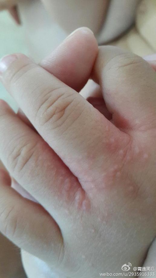 宝宝14个月了,前几天手指缝里突然起了好多小红疙瘩,涂了尤卓尔不