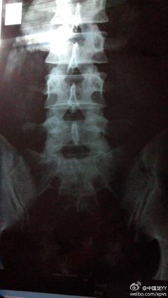 打篮球扭到腰,广州和谐医院的某医生说脊椎有