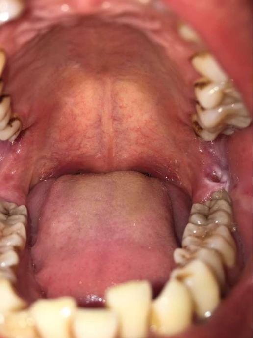 口腔最后面没长牙齿的地方,破了发炎口腔大牙的最后面