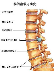 腰椎ct读片椎间盘膨隆,是什么意思