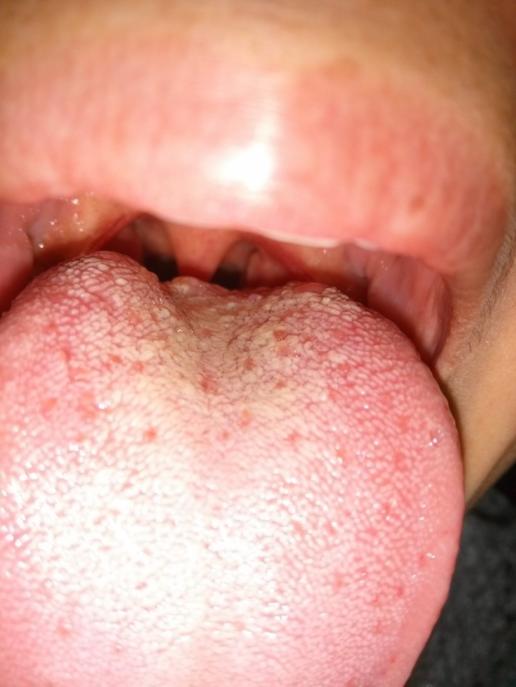 喉咙干痒咳嗽,舌根起了一个大痘痘.