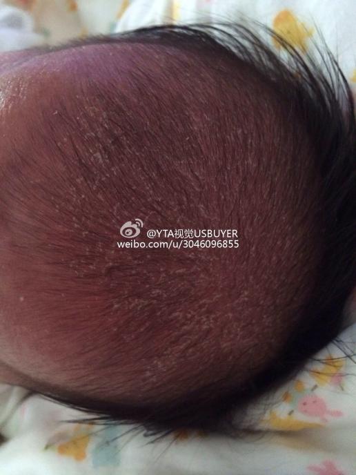 缺蛋白质都会造成宝宝掉发的,  还有的宝宝奶秃是一种正常的新陈代谢