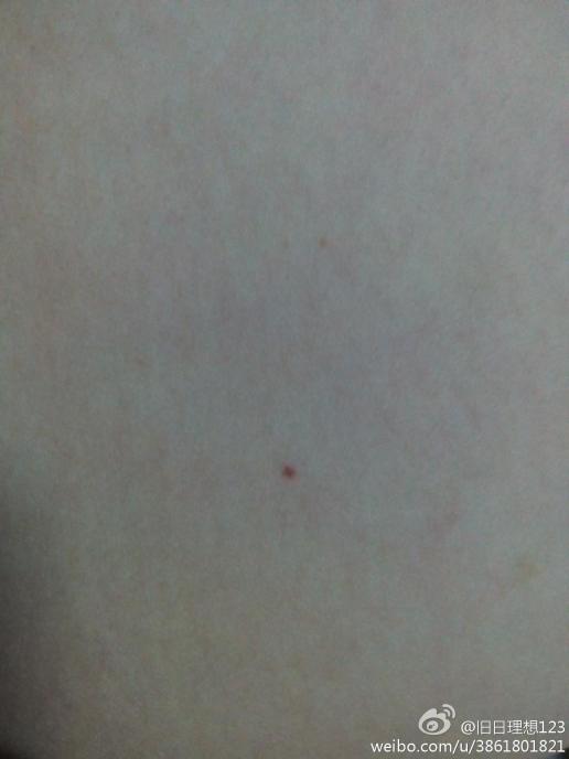 最近手臂和大腿上长这些小红点是什么原因引起的