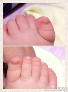 我家宝宝5个多月了,他的大脚趾头有点歪,是畸