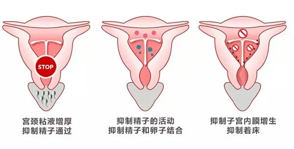 带环避孕的原理是什么_\