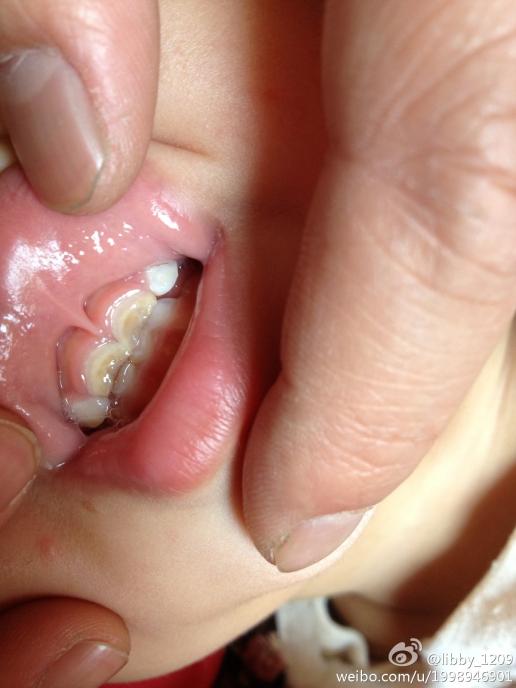 请问宝宝牙齿这样是牙釉质发育不良还是蛀牙?