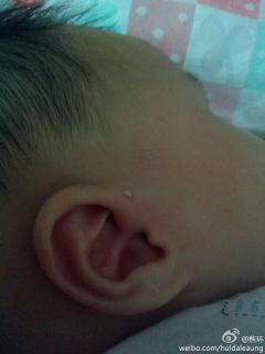 宝宝耳朵边上有个小孔,还能挤出很多白色的东