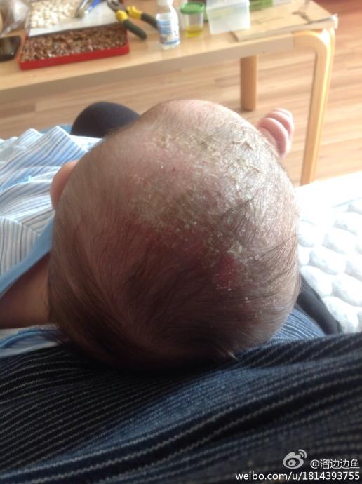 3个月大宝宝头皮湿疹怎么办?抓破了能酒精消毒吗?