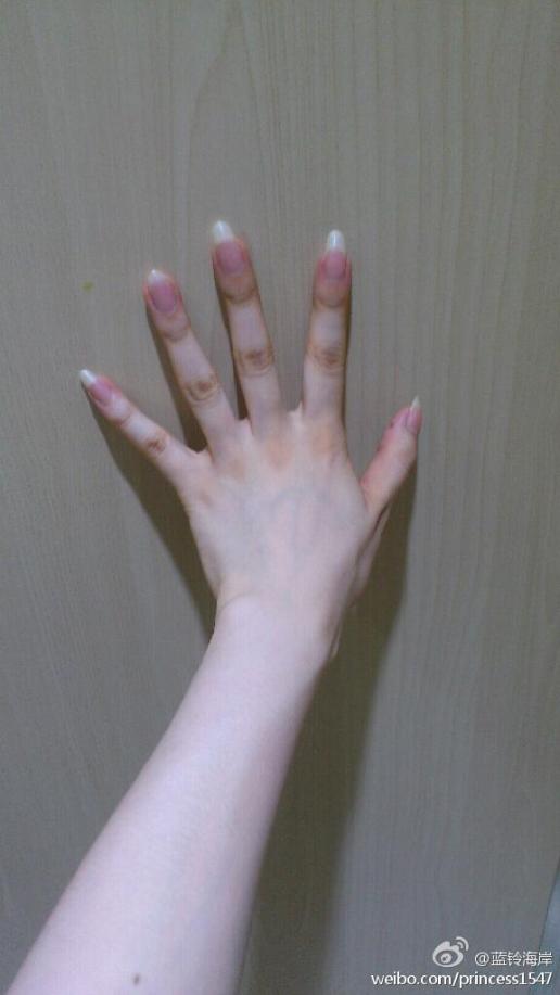 为什么手背的指关节处会发黄呢,手心也黄,已经三个多月了……求解