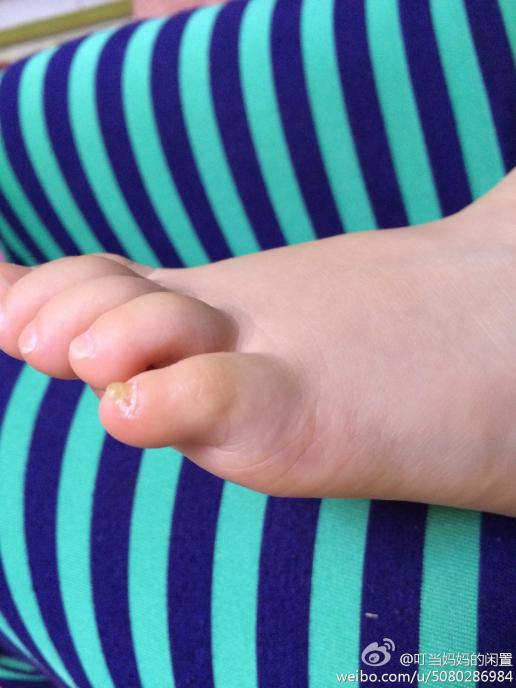 您好,宝宝2岁半,有一只脚的小脚指甲很厚,而且黄,请问