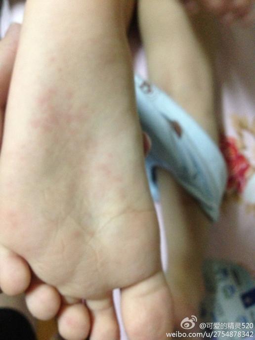 请帮我看看我女儿的脚底上的红点是怎么了?