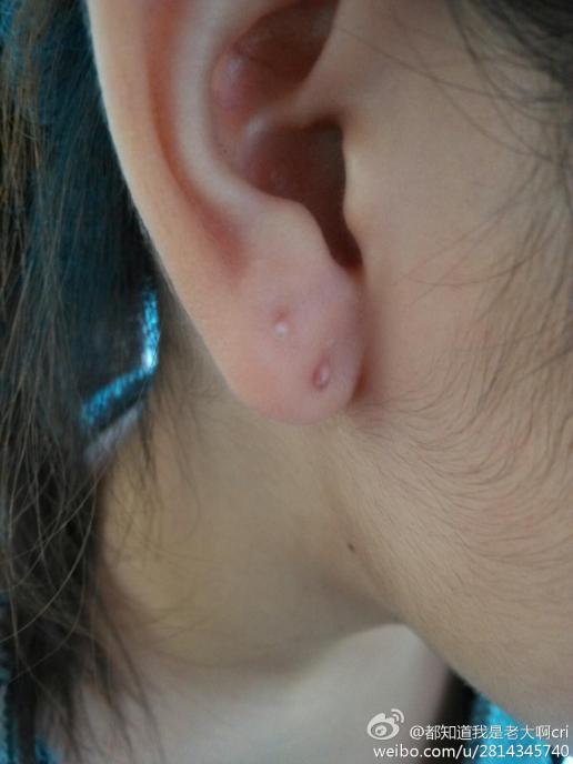 打耳洞引起的疤痕怎么治疗啊?