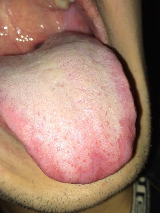 这个舌头是白色念珠真菌感染吗 <br?