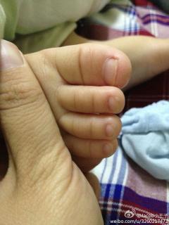 我儿子九个月一侧脚趾趾甲变白变厚,看了附近