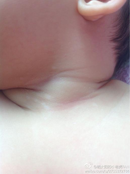 小婴儿脖子长扁平疣图片