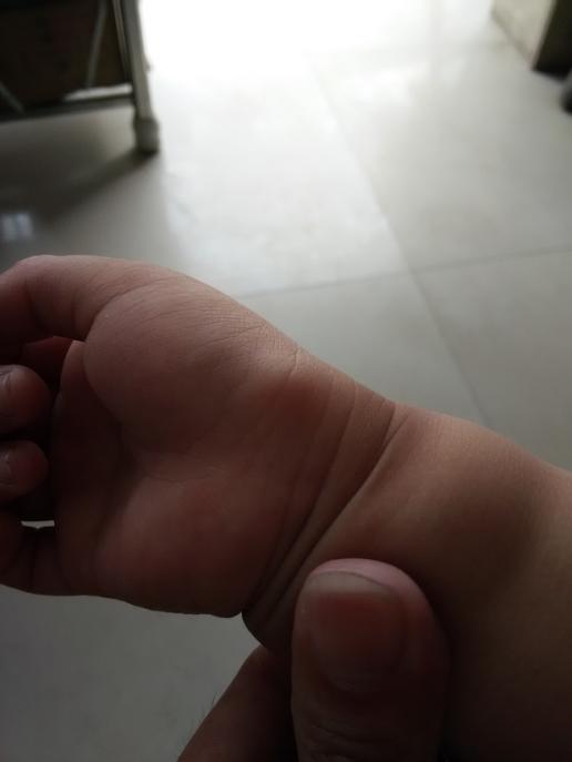 3岁宝宝手腕腱鞘囊肿图片
