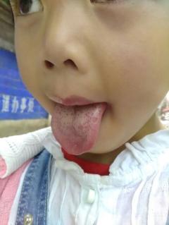 宝宝舌头上有白苔图片图片