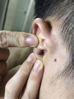 耳朵里面长了个瘤,怎么办?中医专利组方治疗肿瘤效果怎么样?