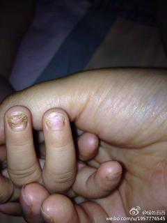 孩子手指甲凹凸不平图片