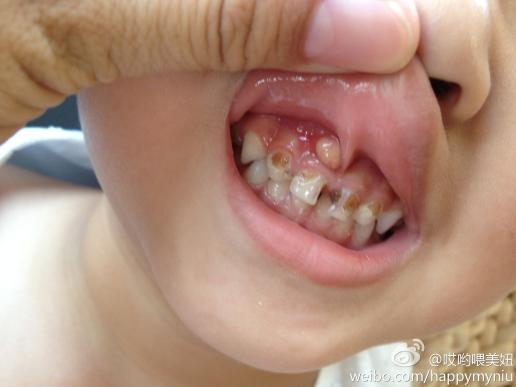 儿童牙龈上长肉疙瘩图图片