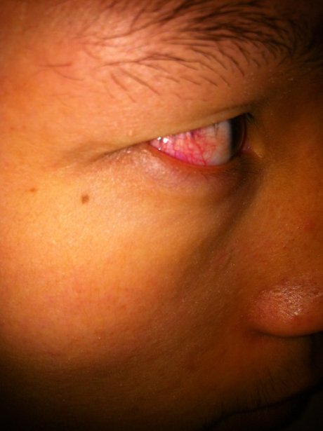 眼睛还是红的听他们说好像是角膜炎不想去医院