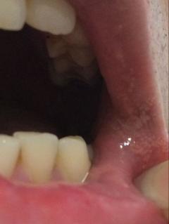 口腔腔壁和嘴角内部都是这种白色点点是什么东西