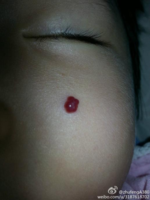 婴儿脸上血管瘤图片图片