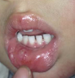 两岁宝宝小嘴唇里长了一个白色的疙瘩