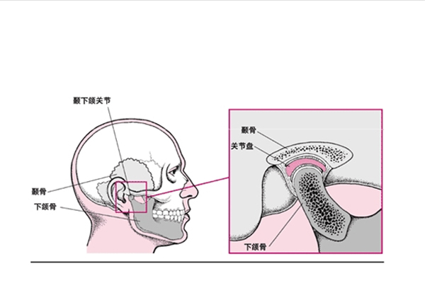 颞下颌关节病并不是罕见病,它和人们的咀嚼习惯,精神紧张等心理因素