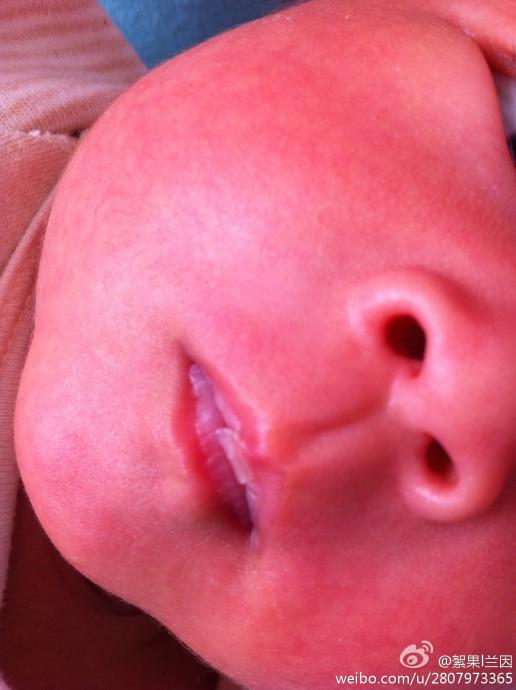 宝宝嘴唇有白斑图片图片