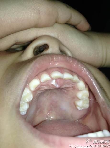 口腔上颚有个牙齿图片