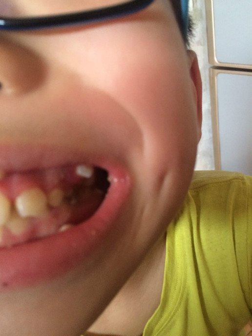 门牙从牙龈上方长出图片