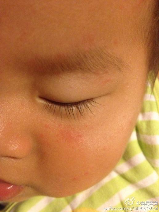 宝宝花粉过敏症状图片图片