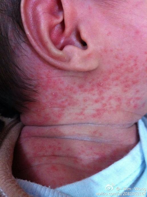 我家宝宝出生十二天,如图所见颈部红点,宝宝平时出汗较多,疑是汗疹?