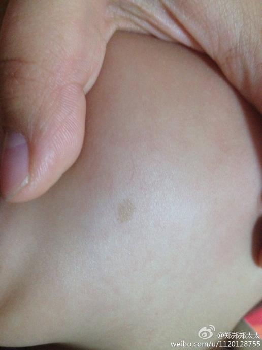 我家宝宝十三个月,右脸颊下巴处有一个斑点,出生时