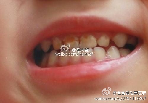 婴儿牙齿釉质钙化图片图片