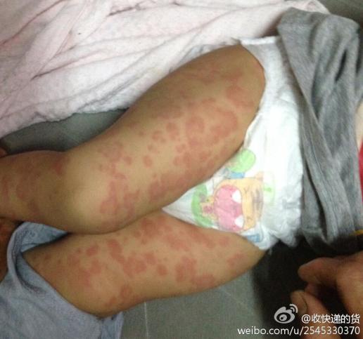 10个月宝宝荨麻疹图片图片