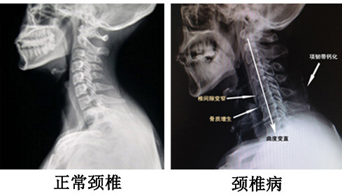 北京哪家专业治疗颈椎病医院