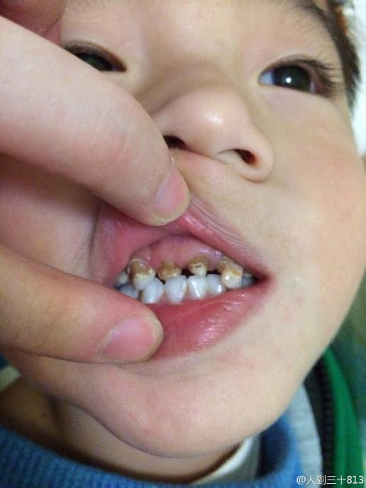 四岁的宝宝牙齿已经成这个样子了,刚开始蛀时医生说没办法等换牙,现?