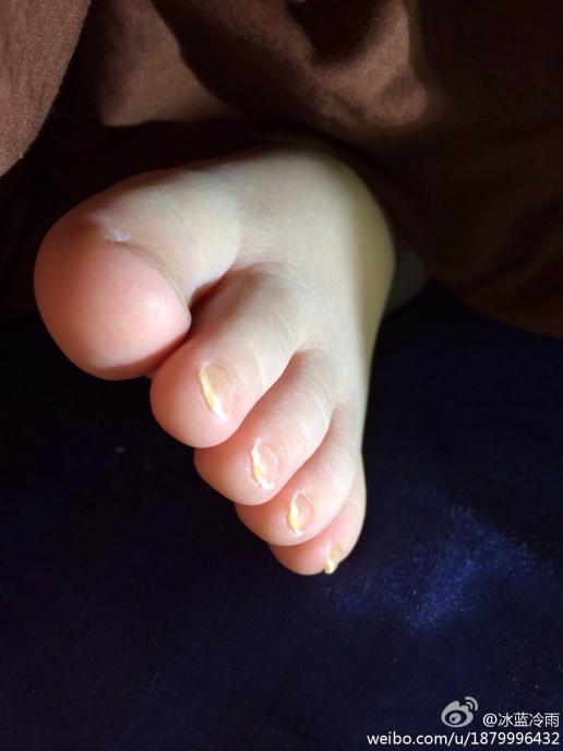 宝宝灰指甲的前兆图片图片