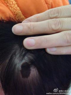 我家宝宝左边头顶有个黑痣,痣上面有头发请问这样的痣是不是要点?