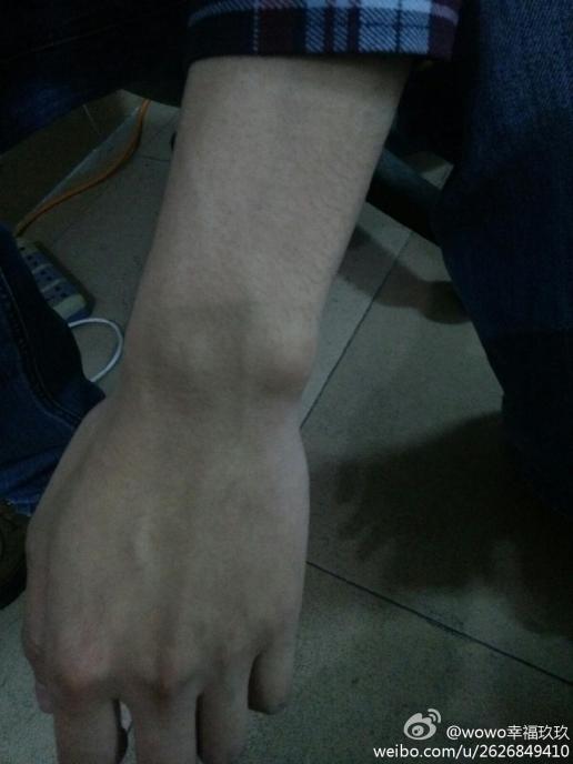 手腕骨膜炎的症状图片图片