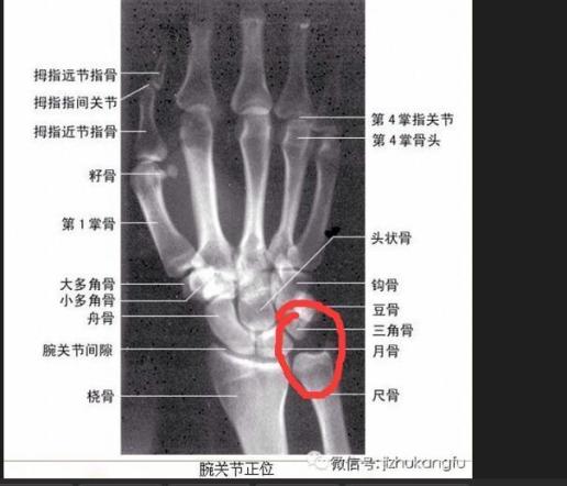 上面一张是我的右手x光片 下面一张是骨骼介绍图 我想问一下 我的手腕