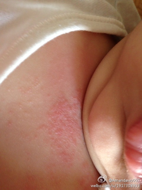 宝宝就胸口有这样的疹子是湿疹吗