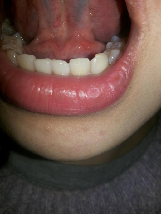 舌头下面根部图片