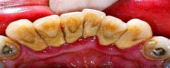 洗牙出血一般是由于牙龈炎或者牙结石过多,牙龈本来就很脆弱,出点血是